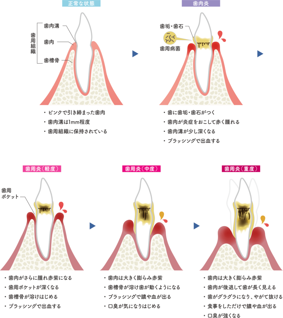 歯周病の進行